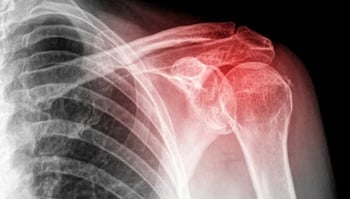 shoulder x-ray